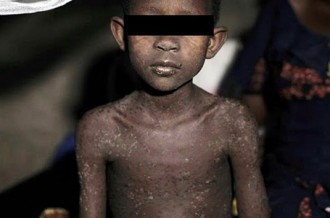 Gabon : La rougeole réapparait à  Libreville et à  lÂ’intérieur